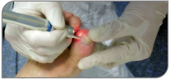лечение ногтя
